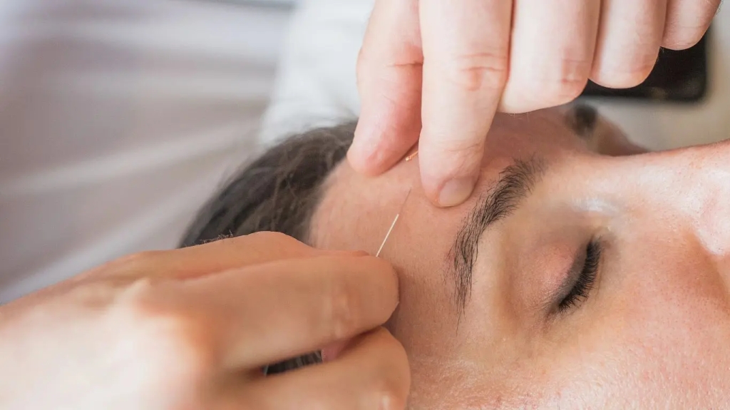 L’acupuncture esthétique traitement pour les rides du visage